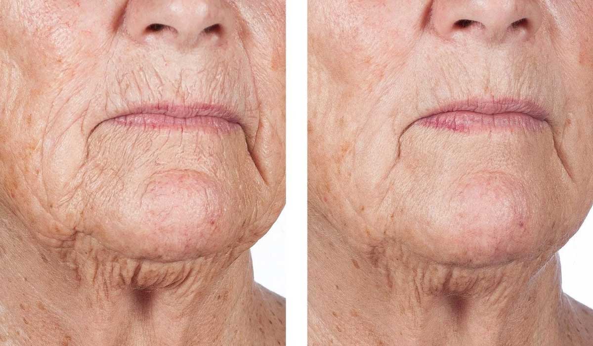 تفاوت پوست گردن چروکیده و پیر با پوست سفت و جوان بعد از مراقبت تفاوت پوست گردن چروکیده و پیر با پوست سفت و جوان بعد از مراقبت